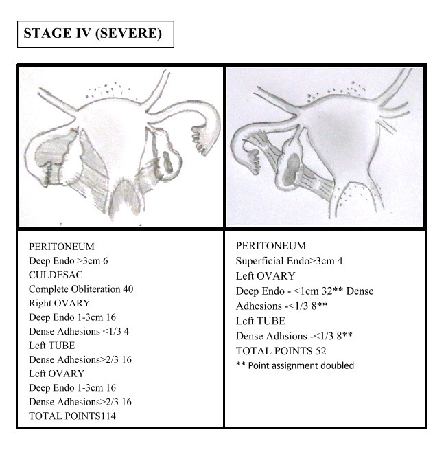 Types Of Endometriosis Staging Of Endometriosis Patientsengage